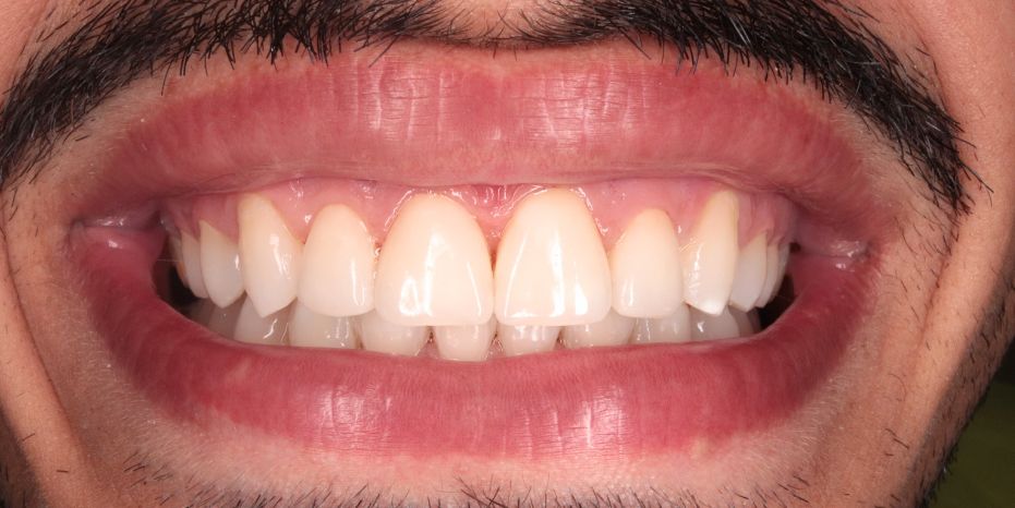ESTÉTICA Y CARILLAS DENTALES   MURCIA